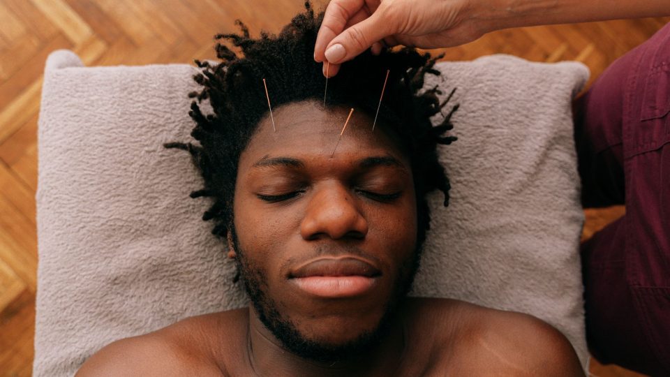A man receives relaxing acupuncture treatment, promoting health and wellness through alternative medicine.