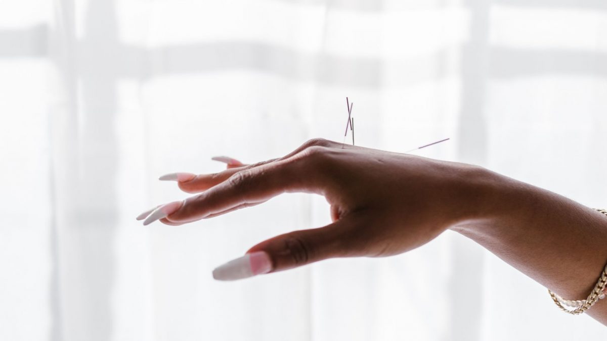 Close-up view of acupuncture needles on a woman's hand against a light background.